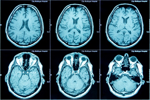 Brain Health Assessments, Online Memory Tests